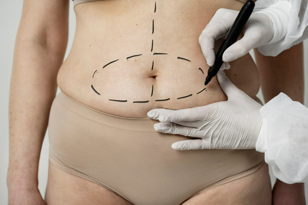 Bariatric Surgery