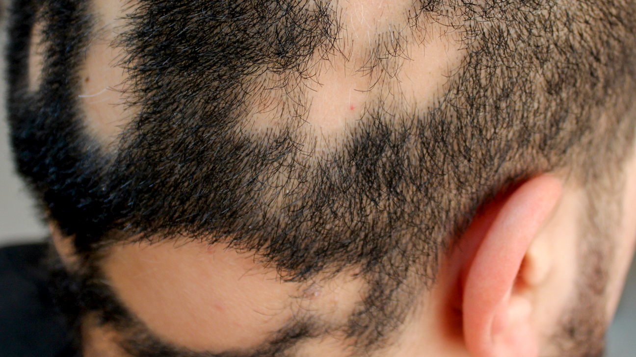 how-does-diet-affect-hair-loss-paris-diet-solution